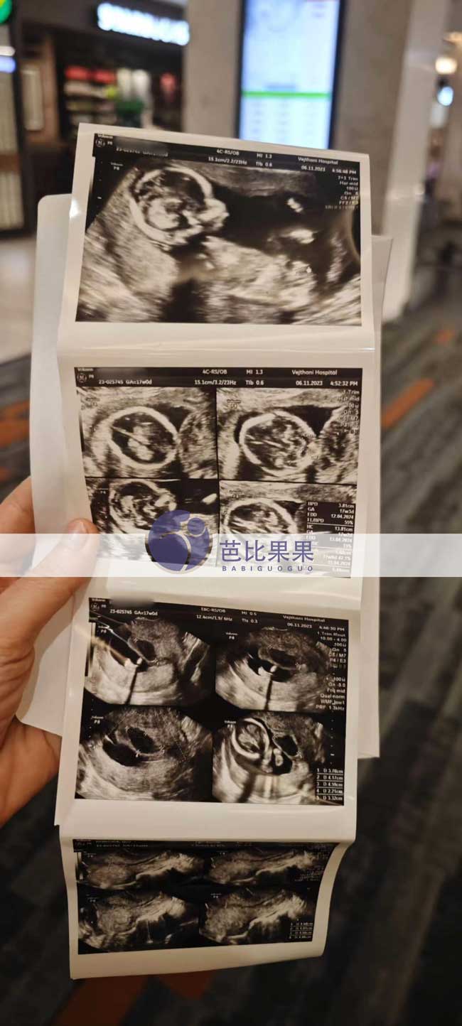泰国试管妈妈孕17周B超