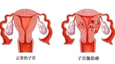 正常的子宫和子宫腺肌症对比