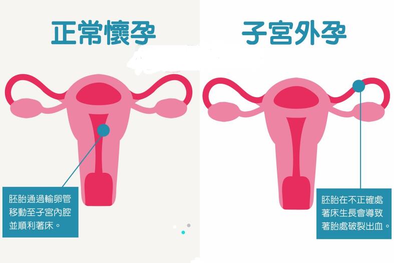 试管婴儿移植后怎么降低宫外孕