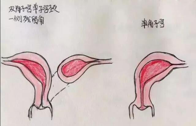 单角子宫