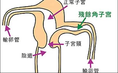 单角子宫对自然怀孕的影响