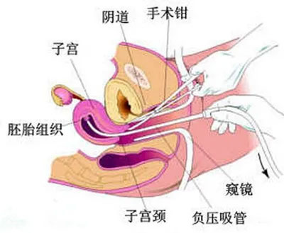 宫腔操作史