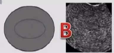 B型内膜