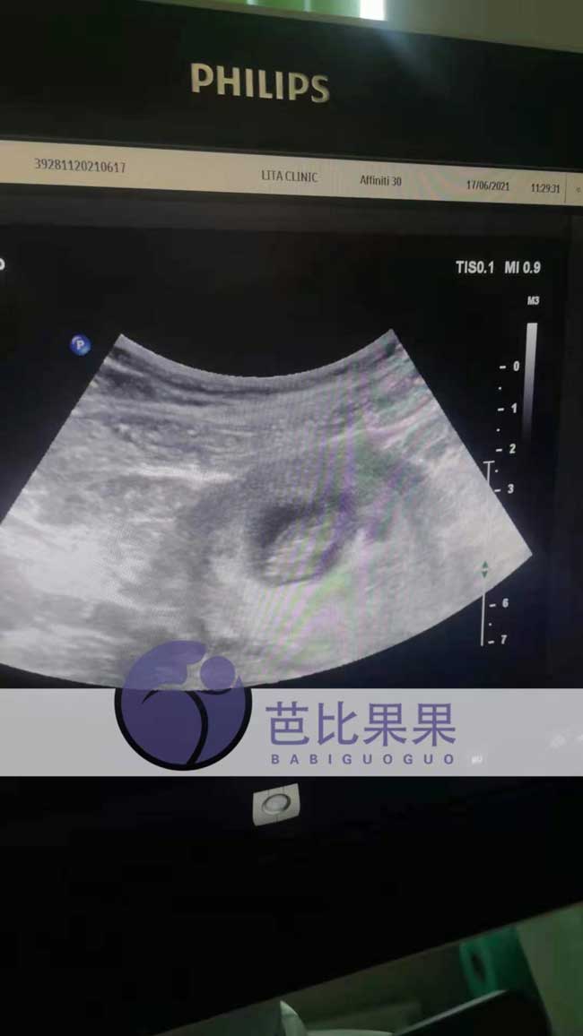 乌克兰试管孕母做B超