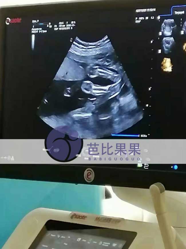 乌克兰代理孕母B超