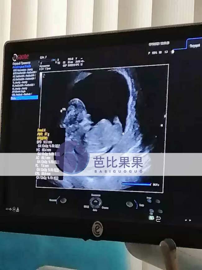 乌克兰代理孕母B超