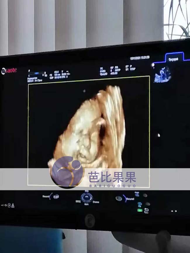 乌克兰代理孕母做B超