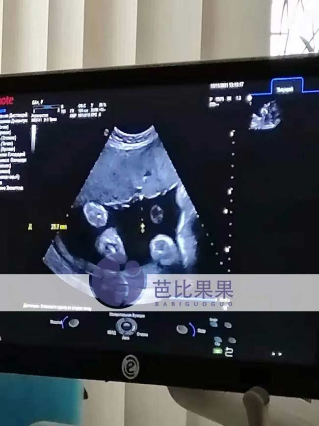 乌克兰代理孕母做B超