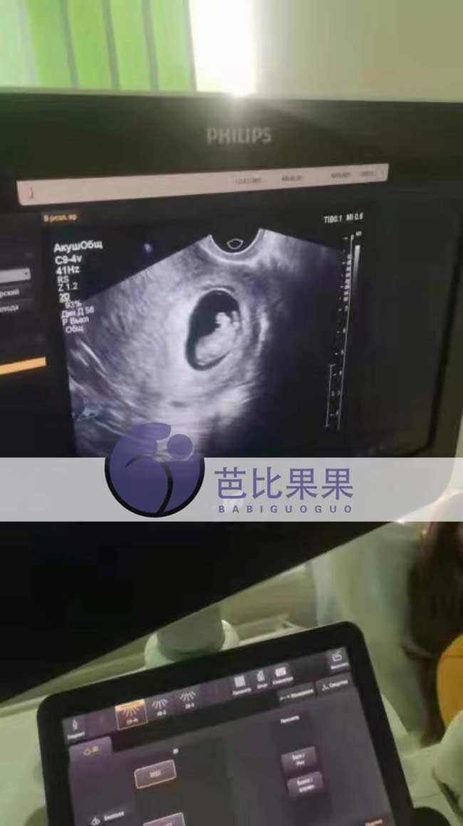 乌克兰代理孕母第二次B超