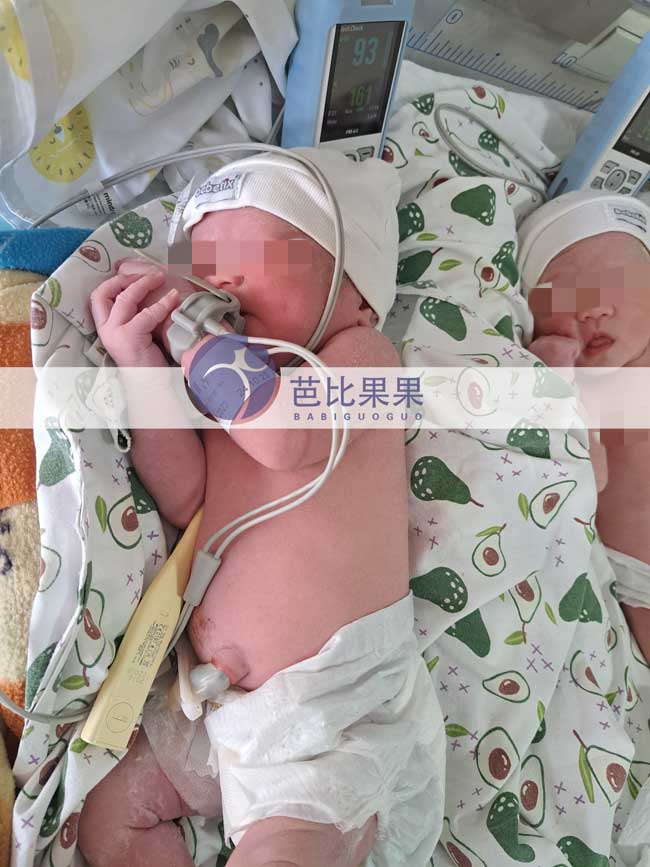 格鲁吉亚自卵试管双胞胎出生