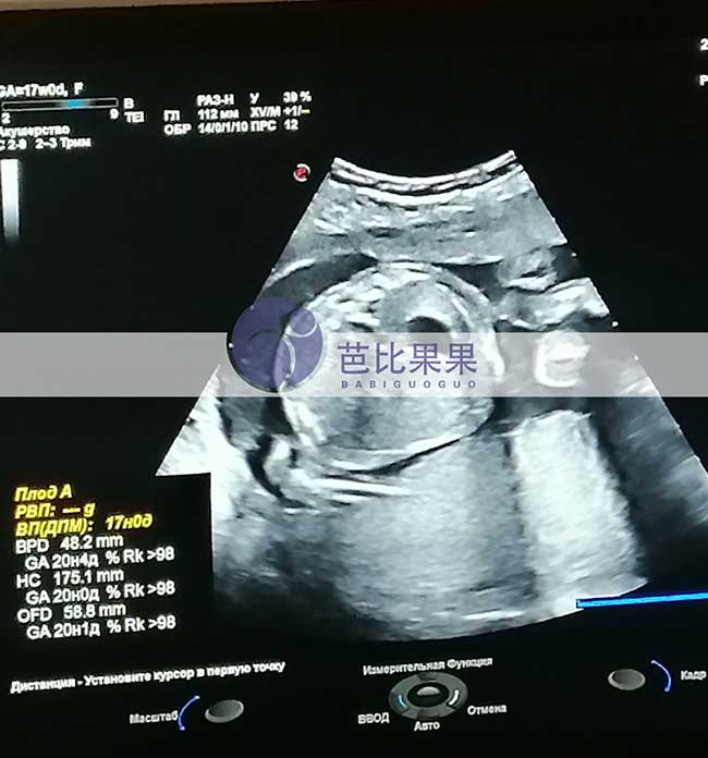 乌克兰试管妈妈孕17周B超