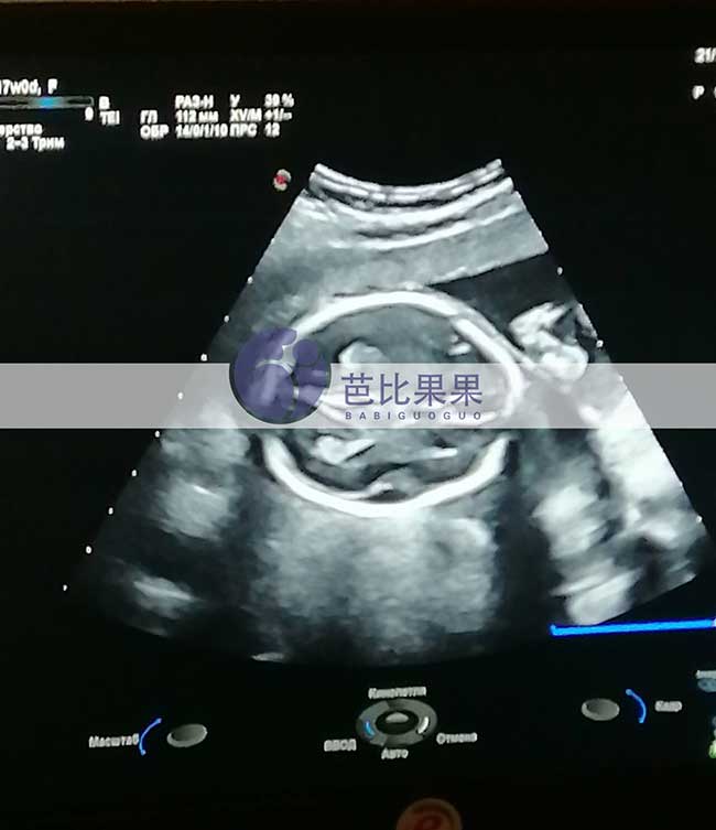 乌克兰试管妈妈孕17周B超