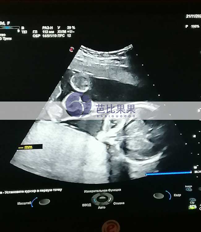 乌克兰试管妈妈孕17周B超