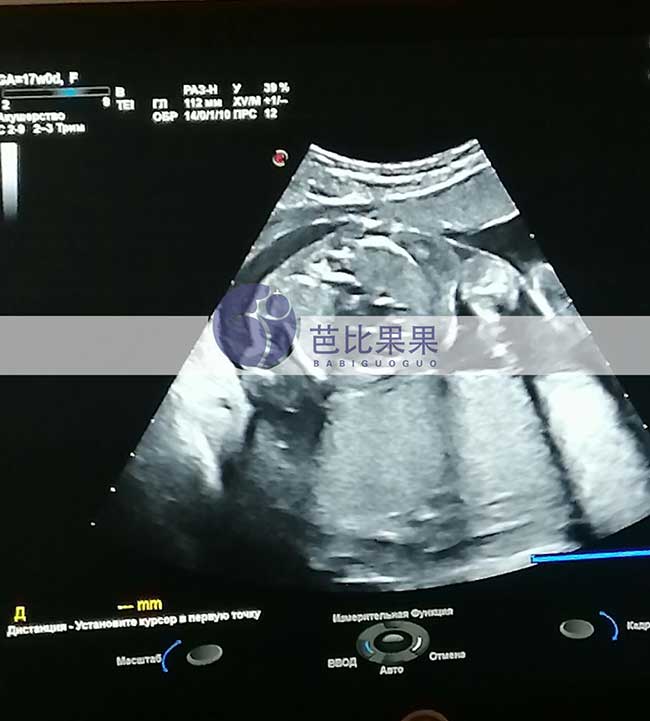 乌克兰试管妈妈孕17周B超