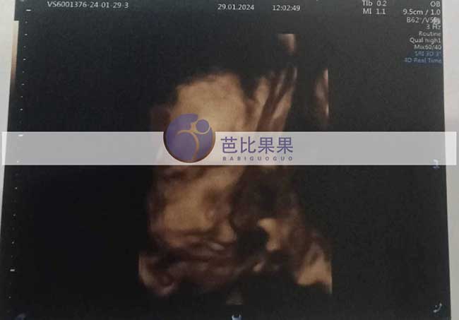 泰国试管妈妈做四维彩超