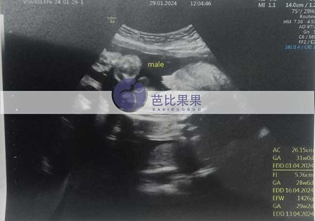 泰国试管妈妈做四维彩超