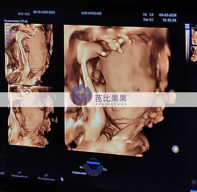 乌克兰试管妈妈四维彩超